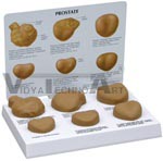 Human Male Prostate Anatomy Model with Patient Education Card